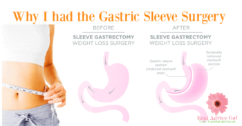 Why I had the Gastric Sleeve Surgery