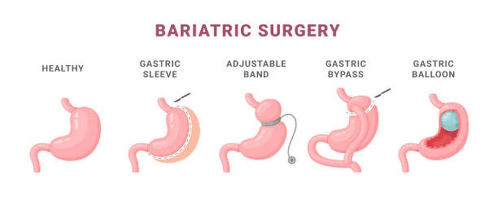 What is Gastric Sleeve Surgery?